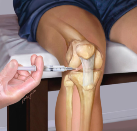 Knee Pain Relief Codes benefits