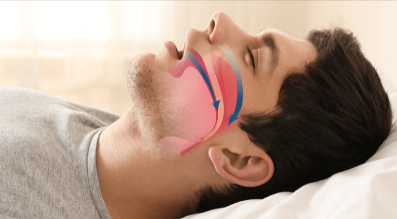 The Stop Snoring and Sleep Apnea Program Benefits